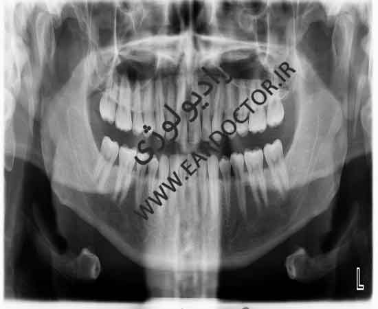 عکس رادیولوژی از فک و دندان